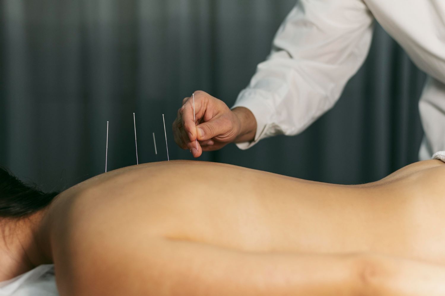 Acupuncture Treatment